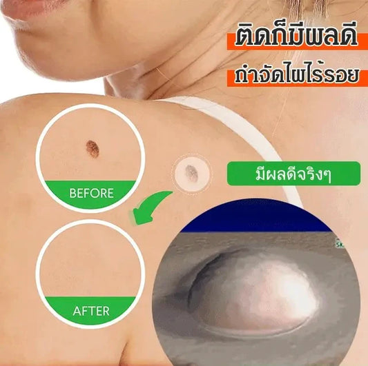 Traceless mole removal stickers